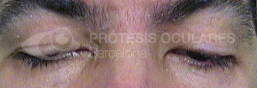 After image